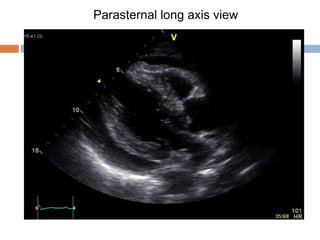 Parasternal long axis view
 