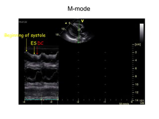 Beginning of systole
ES DC
M-mode
 