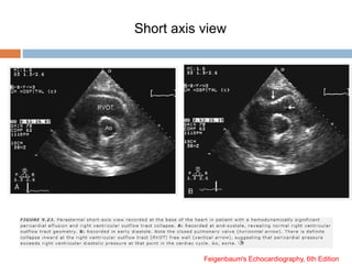 Short axis view
Feigenbaum's Echocardiography, 6th Edition
 