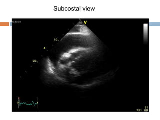 Subcostal view
 