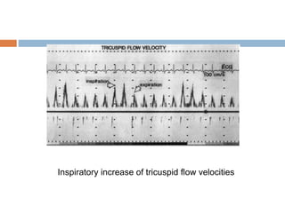 Inspiratory increase of tricuspid flow velocities
 