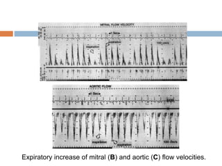 Expiratory increase of mitral (B) and aortic (C) flow velocities.
 