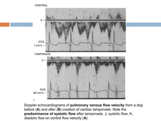 Doppler echocardiograms of pulmonary venous flow velocity from a dog
before (A) and after (B) creation of cardiac tamponade. Note the
predominance of systolic flow after tamponade. J, systolic flow; K,
diastolic flow on control flow velocity (A).
 