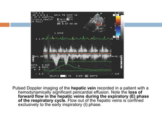 Pulsed Doppler imaging of the hepatic vein recorded in a patient with a
hemodynamically significant pericardial effusion. Note the loss of
forward flow in the hepatic veins during the expiratory (E) phase
of the respiratory cycle. Flow out of the hepatic veins is confined
exclusively to the early inspiratory (I) phase.
 