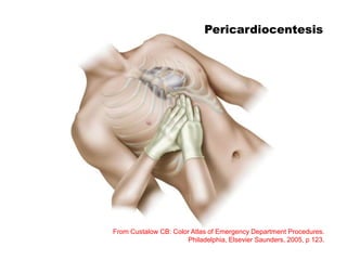 From Custalow CB: Color Atlas of Emergency Department Procedures.
Philadelphia, Elsevier Saunders, 2005, p 123.
Pericardiocentesis
 