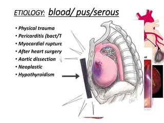 ETIOLOGY: blood/ pus/serous
• Physical trauma
• Pericarditis (bact/TB/HIV)
• Myocardial rupture
• After heart surgery
• Aortic dissection
• Neoplastic
• Hypothyroidism
 