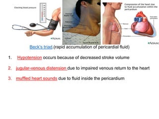 Beck's triad.(rapid accumulation of pericardial fluid)
1. Hypotension occurs because of decreased stroke volume
2. jugular-venous distension due to impaired venous return to the heart
3. muffled heart sounds due to fluid inside the pericardium
 