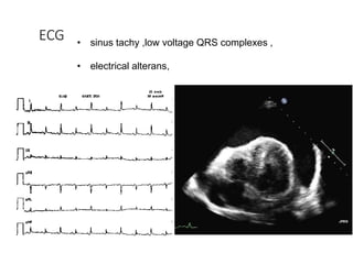 ECG • sinus tachy ,low voltage QRS complexes ,
• electrical alterans,
 