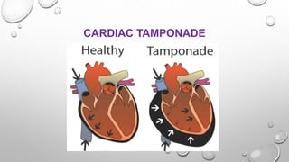 CARDIAC TAMPONADE
 