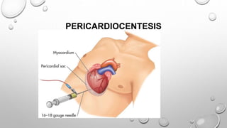 PERICARDIOCENTESIS
 