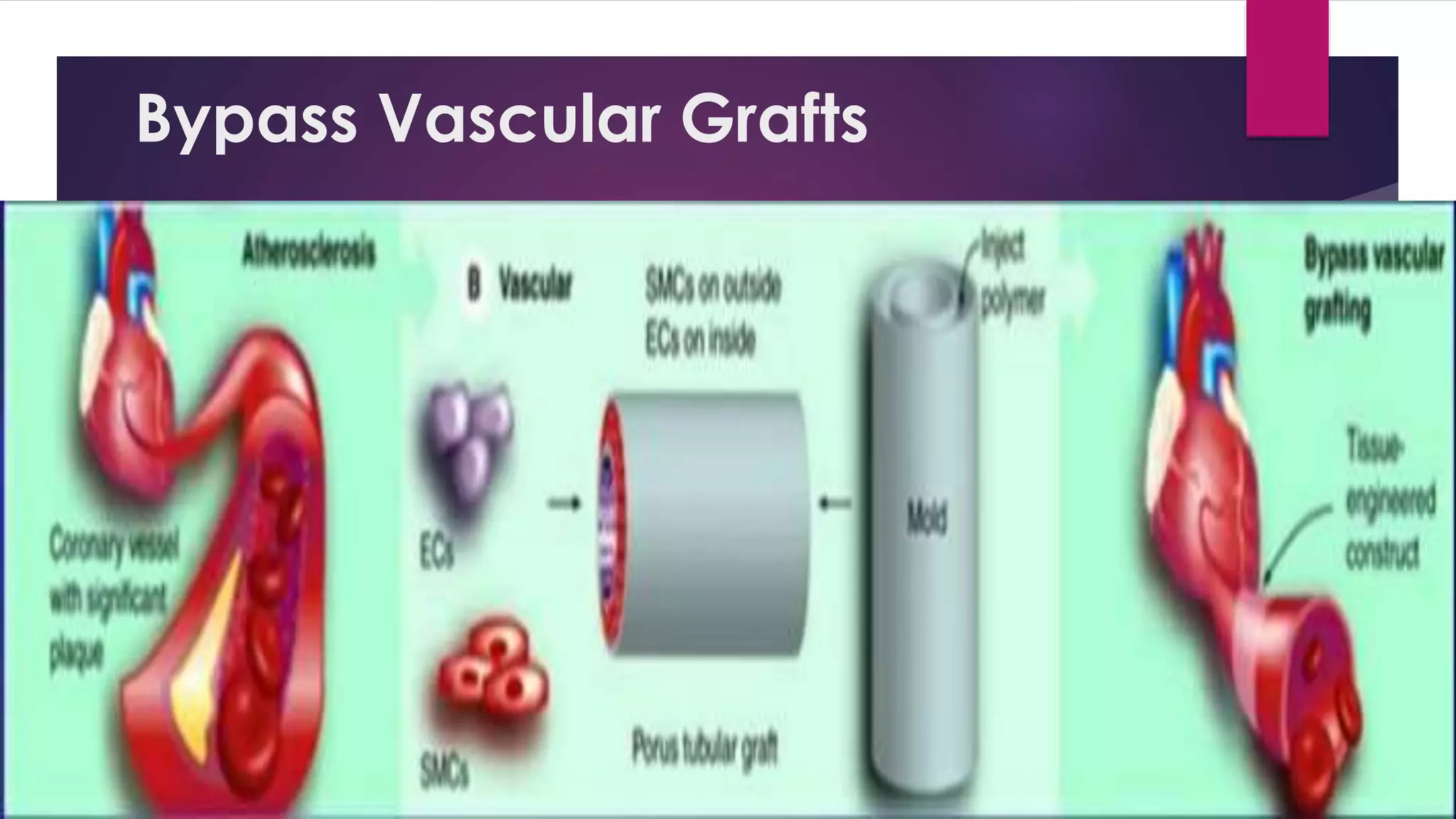 Bypass Vascular Grafts
 