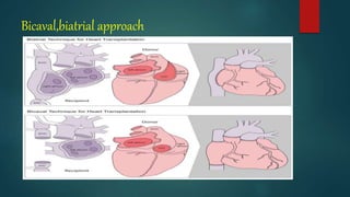 Bicaval,biatrial approach
 