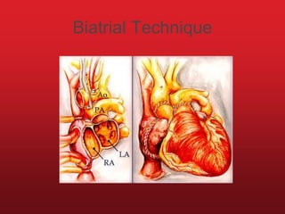 Biatrial Technique
 