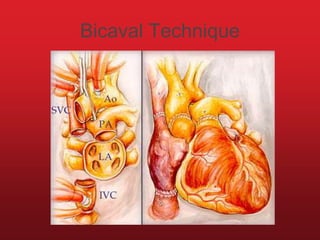 Bicaval Technique
 