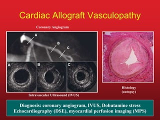 Cardiac Allograft Vasculopathy
Coronary Angiogram
Intravascular Ultrasound (IVUS)
Histology
(autopsy)
Diagnosis: coronary angiogram, IVUS, Dobutamine stress
Echocardiography (DSE), myocardial perfusion imaging (MPS)
 