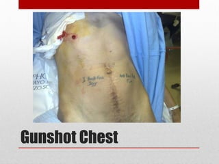 Gunshot Chest
 