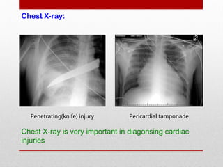 Penetrating(knife) injury Pericardial tamponade
Chest X-ray is very important in diagonsing cardiac
injuries
Chest X-ray:
 