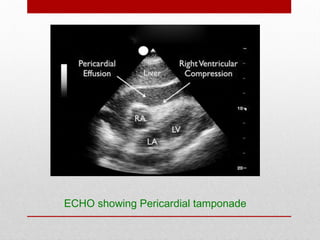 ECHO showing Pericardial tamponade
 