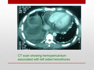 CT scan showing hemopericardum
associated with left sided hemothorax
 
