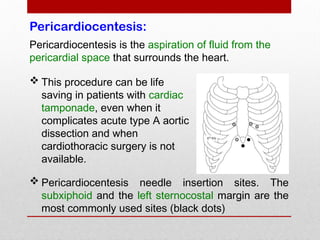 Pericardiocentesis:
 Pericardiocentesis needle insertion sites. The
subxiphoid and the left sternocostal margin are the
most commonly used sites (black dots)
Pericardiocentesis is the aspiration of fluid from the
pericardial space that surrounds the heart.
 This procedure can be life
saving in patients with cardiac
tamponade, even when it
complicates acute type A aortic
dissection and when
cardiothoracic surgery is not
available.
 