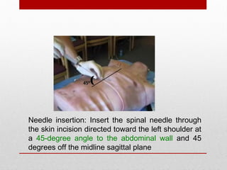 Needle insertion: Insert the spinal needle through
the skin incision directed toward the left shoulder at
a 45-degree angle to the abdominal wall and 45
degrees off the midline sagittal plane
 