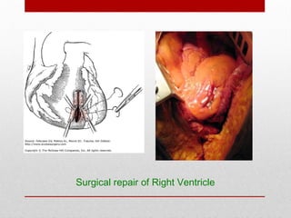 Surgical repair of Right Ventricle
 
