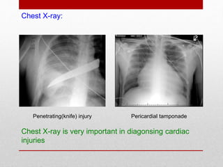 Penetrating(knife) injury Pericardial tamponade
Chest X-ray is very important in diagonsing cardiac
injuries
Chest X-ray:
 
