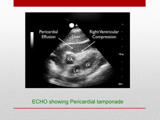 ECHO showing Pericardial tamponade
 