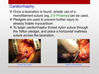 Cardiorrhaphy:
 Once a laceration is found, simple use of a
monofilament suture (eg, 2-0 Prolene) can be used.
 Pledgets are used to prevent further injury to
already friable myocardium.
 To begin cardiorrhaphy thread nylon suture through
the Teflon pledget, and place a horizontal mattress
suture across the laceration.
Locate the injury Suture threading
 