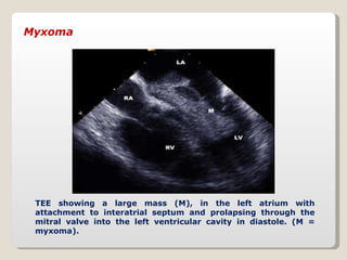 Myxoma TEE showing a large mass (M), in the left atrium with attachment to interatrial septum and prolapsing through the m...
