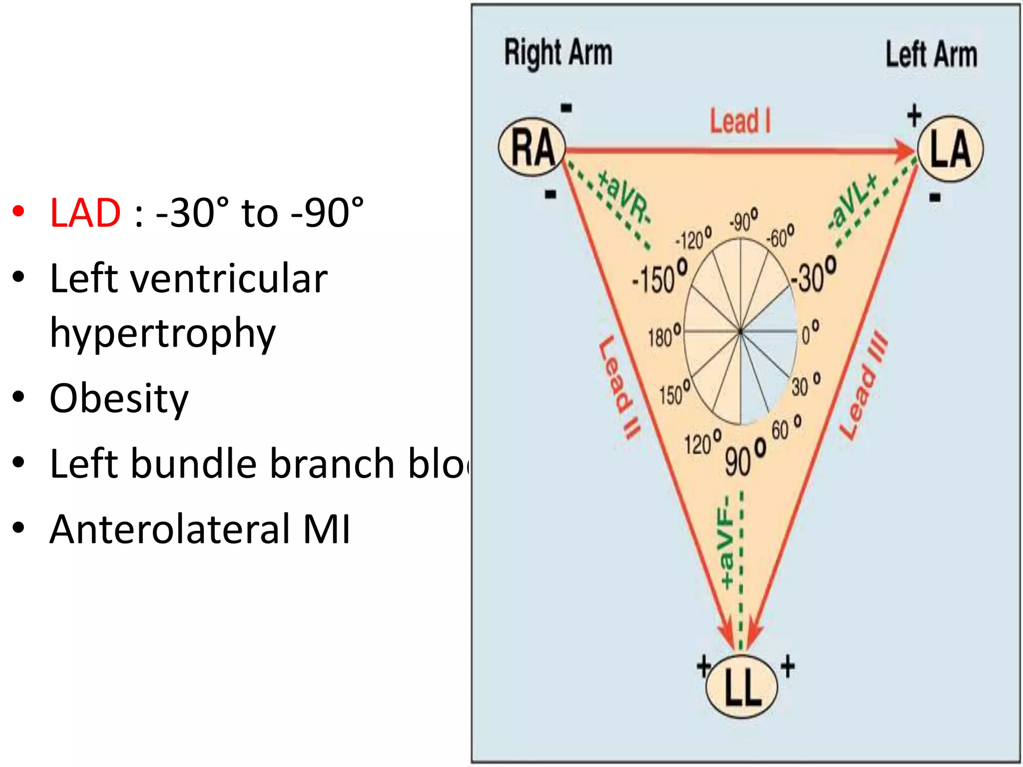 • LAD : -30° to -90°
• Left ventricular
hypertrophy
• Obesity
• Left bundle branch block
• Anterolateral MI
 