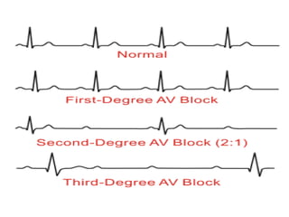 Normal Heart Vector Cardiac vector and axis | PPTX