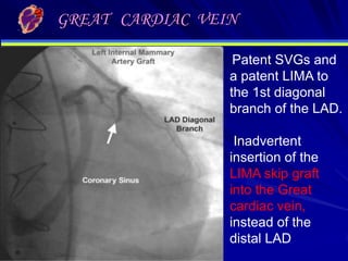 GREAT CARDIAC VEIN
Patent SVGs and
a patent LIMA to
the 1st diagonal
branch of the LAD.

.

Inadvertent
insertion of the
LIMA skip graft
into the Great
cardiac vein,
instead of the
distal LAD

 