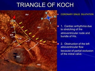 TRIANGLE OF KOCH
.

CORONARY SINUS DILATATION

1. Cardiac arrhythmia due
to stretching of the
atrioventricular node and
bundle of His.
2. Obstruction of the left
atrioventricular flow
because of partial occlusion
of the mitral valve.

a

 