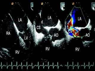 Figure 1. Transesophageal echocardiography revealed both atrial and right ventricular
enlargement (left), a defect of the partial coronary sinus (middle), and shunt of the left atrium
to the dilated coronary sinus (right) at the near longitudinal plane.

 