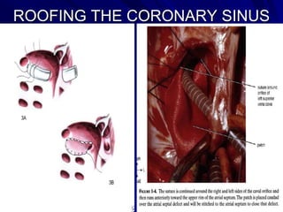 ROOFING THE CORONARY SINUS

 