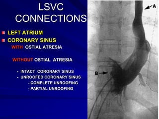 LSVC
CONNECTIONS
LEFT ATRIUM
CORONARY SINUS
WITH OSTIAL ATRESIA
WITHOUT OSTIAL ATRESIA
- INTACT CORONARY SINUS
- UNROOFED CORONARY SINUS
- COMPLETE UNROOFING
- PARTIAL UNROOFING

 