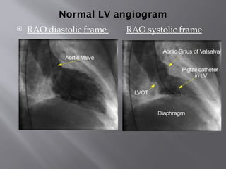 Cardiac Ventriculography - DR SANJAY.pptx