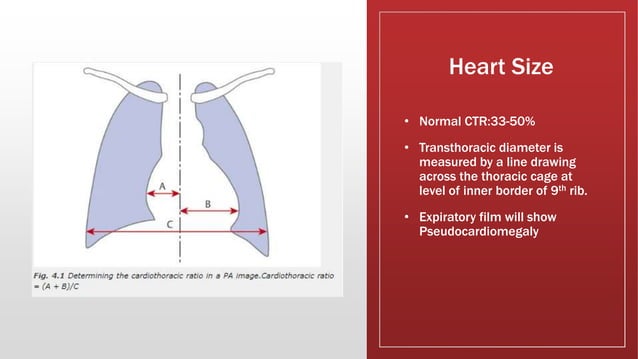 Cardiac X-ray .pptx | Lung and Respiratory Health | Diseases and Conditions