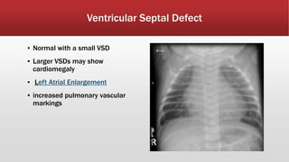 Vsd Size Classification Cardiac X-ray .pptx