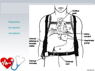 Dispositivo

de soporte

circulatorio
 