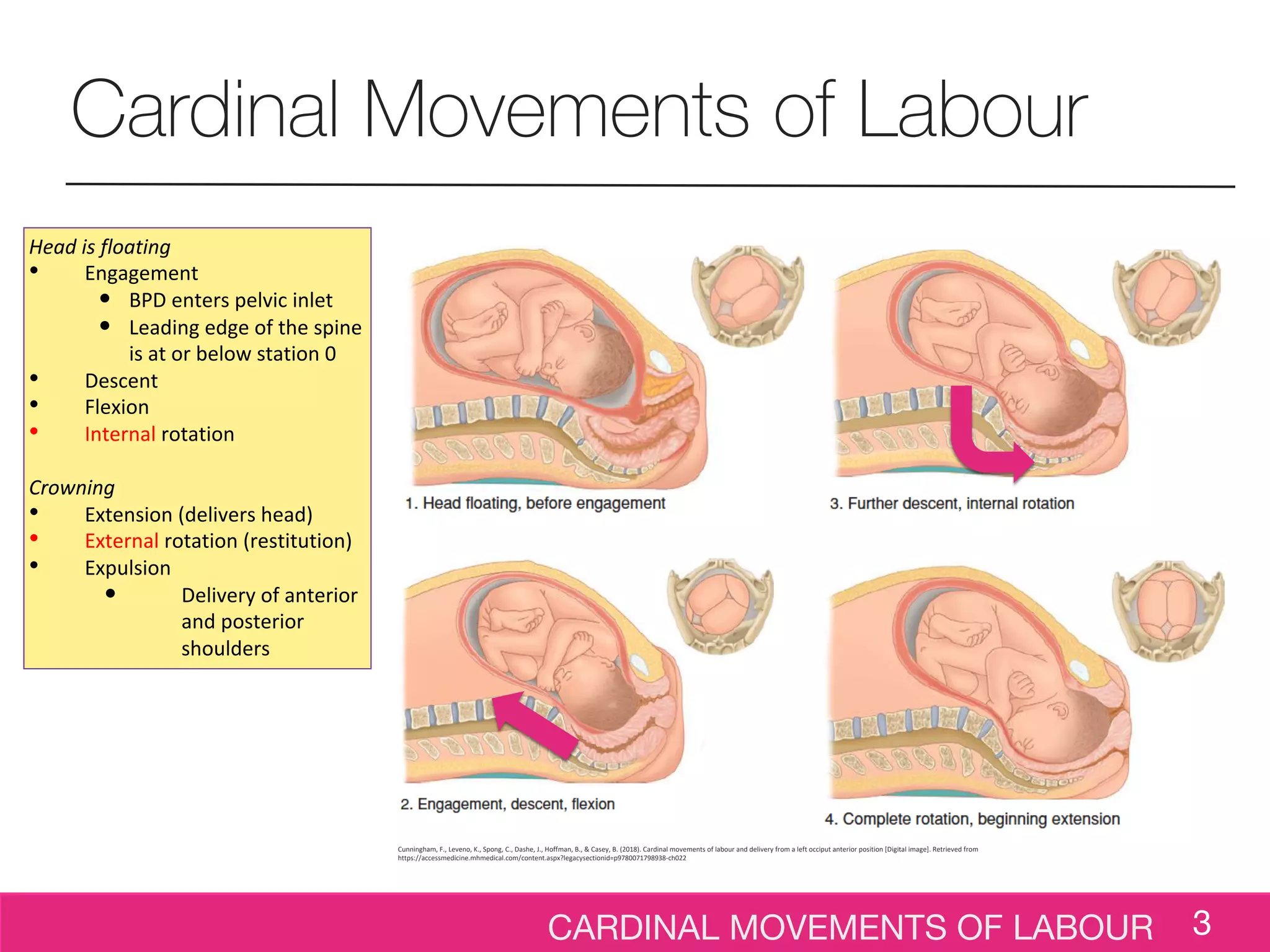 CARDINAL MOVEMENTS OF LABOUR 3
Cardinal Movements of Labour
Head is floating
• Engagement
• BPD enters pelvic inlet
• Leading edge of the spine
is at or below station 0
• Descent
• Flexion
• Internal rotation
Crowning
• Extension (delivers head)
• External rotation (restitution)
• Expulsion
• Delivery of anterior
and posterior
shoulders
Cunningham, F., Leveno, K., Spong, C., Dashe, J., Hoffman, B., & Casey, B. (2018). Cardinal movements of labour and delivery from a left occiput anterior position [Digital image]. Retrieved from
https://accessmedicine.mhmedical.com/content.aspx?legacysectionid=p9780071798938-ch022
 
