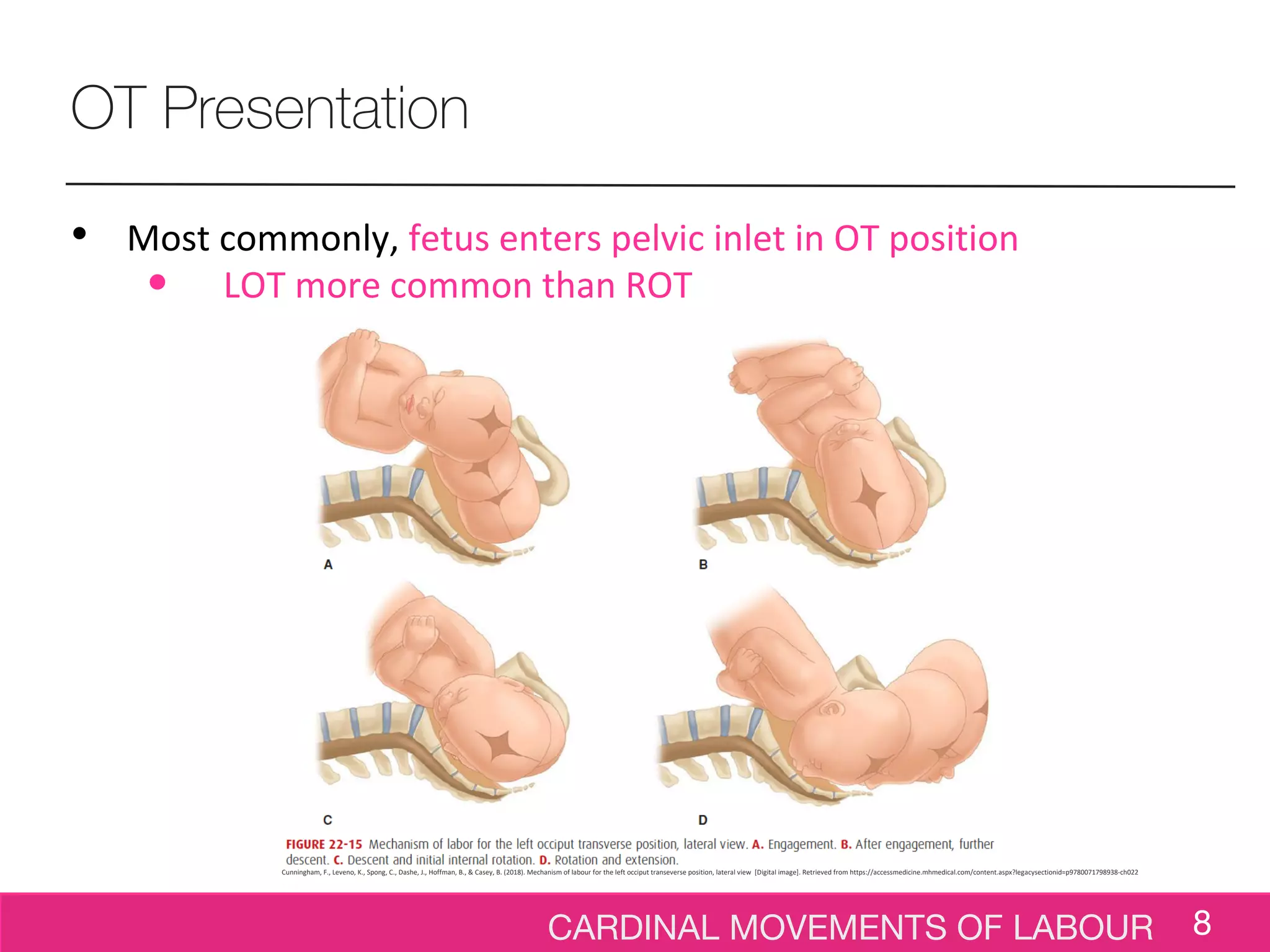 CARDINAL MOVEMENTS OF LABOUR 8
OT Presentation
• Most commonly, fetus enters pelvic inlet in OT position
• LOT more common than ROT
Cunningham, F., Leveno, K., Spong, C., Dashe, J., Hoffman, B., & Casey, B. (2018). Mechanism of labour for the left occiput transeverse position, lateral view [Digital image]. Retrieved from https://accessmedicine.mhmedical.com/content.aspx?legacysectionid=p9780071798938-ch022
 