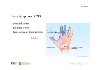 False Symptoms of CTS
April 28, 2016
66British Consulate , Chicago IL
• Postural Issues
• Slumped Torso
• Neurovascular Compression
- - Zacharkow
 
