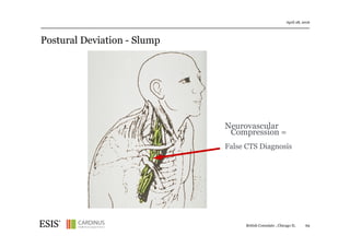 Postural Deviation - Slump
April 28, 2016
British Consulate , Chicago IL 69
Neurovascular
Compression =
False CTS Diagnosis
This image cannot currently be displayed.
 