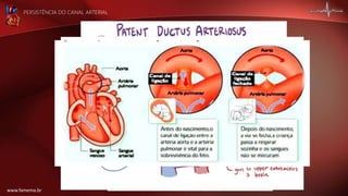 PERSISTÊNCIA DO CANAL ARTERIAL
www.famema.br
 