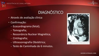 PERSISTÊNCIA DO CANAL ARTERIAL
MOORE & PERSAUD, 2008.
• Através de avaliação clínica
• Confirmação:
– Ecocardiograma (fetal);
– Tomografia;
– Ressonância Nuclear Magnética;
– Cintilografia;
– Ultrassonografia Obstétrica;
– Teste de Caminhada de 6 minutos.
 