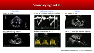Rvd Sign Selexipag in treatment of Pulmonary Arterial Hypertension (Cardiology ...