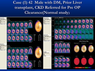Case (1) 42 Male with DM, Prior LiverCase (1) 42 Male with DM, Prior Liver
transplant, CKD Referred for Pre OPtransplant, CKD Referred for Pre OP
Clearance(Normal studyClearance(Normal study))
 