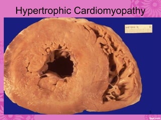 Hypertrophic Cardiomyopathy
5
 